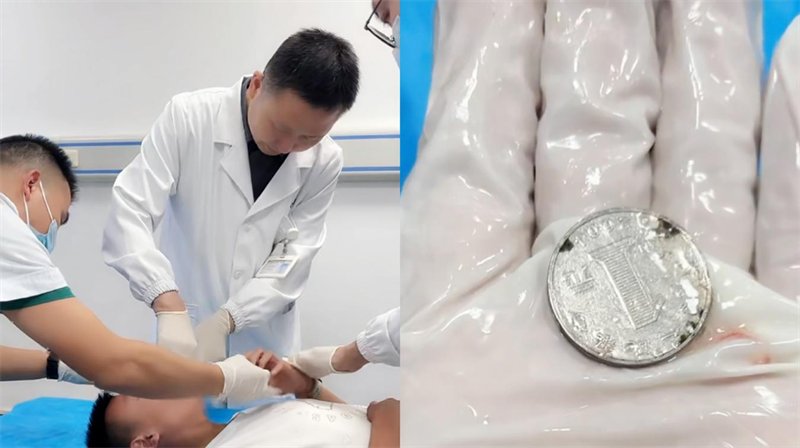 陈沛用导尿管无创取出硬币。黄喜摄